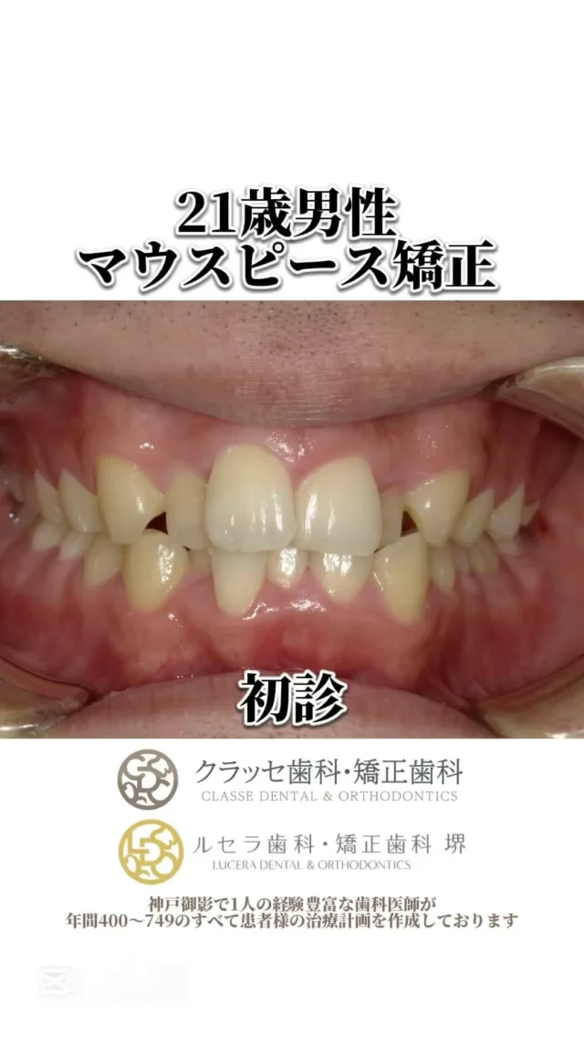 上下顎叢生に対する非抜歯矯正治療
#神戸矯正歯科 #マウスピース矯正 #インビザライン