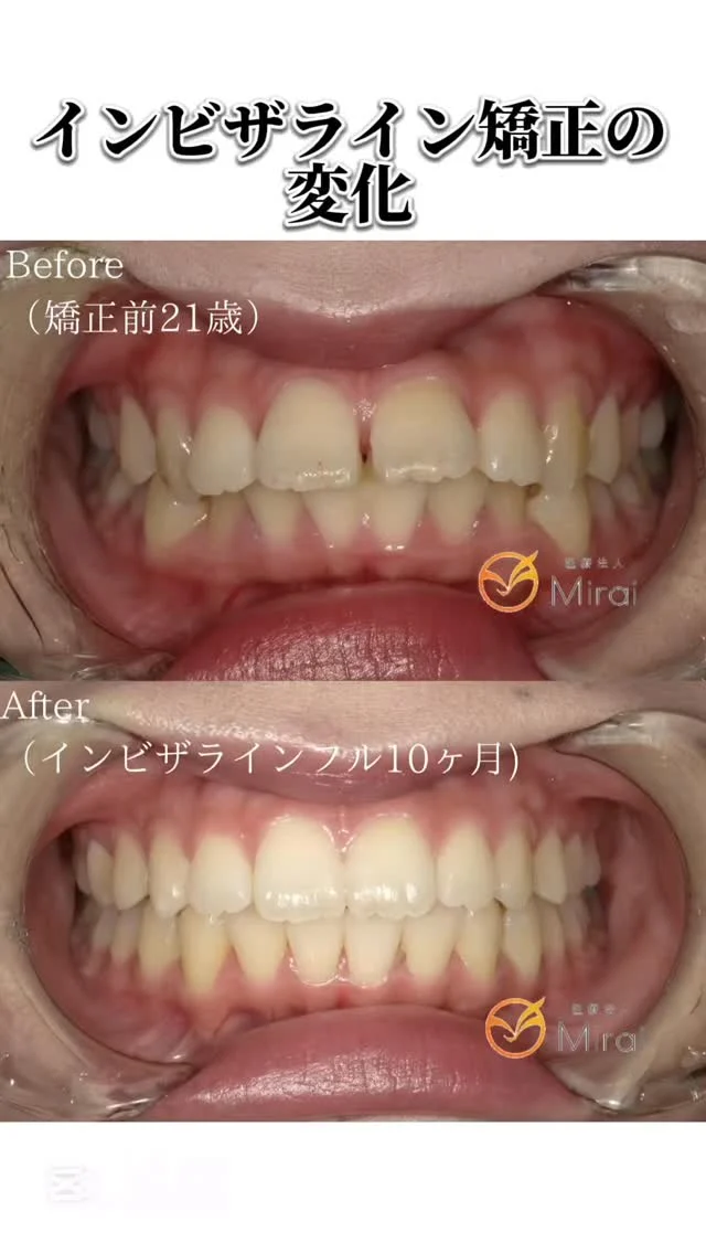 矯正の変化をまとめてみた📘🦷

①21歳女性 10ヶ月 上下叢生を伴う前突を非抜歯で
治療した症例
②21歳女性 1年10ヶ月 反対咬合と叢生に対する非抜歯で治療した症例
③41歳女性 2年4ヶ月 上下顎叢生に対する非抜歯で治療した症例
④13歳男性 1年4ヶ月 上下顎叢生に対する非抜歯で治療した症例
⑤21歳女性 1年2ヶ月 前歯部開噛空隙歯列に対する非抜
歯で治療した症例

#神戸矯正歯科 #マウスピース矯正 #神戸インビザライン
