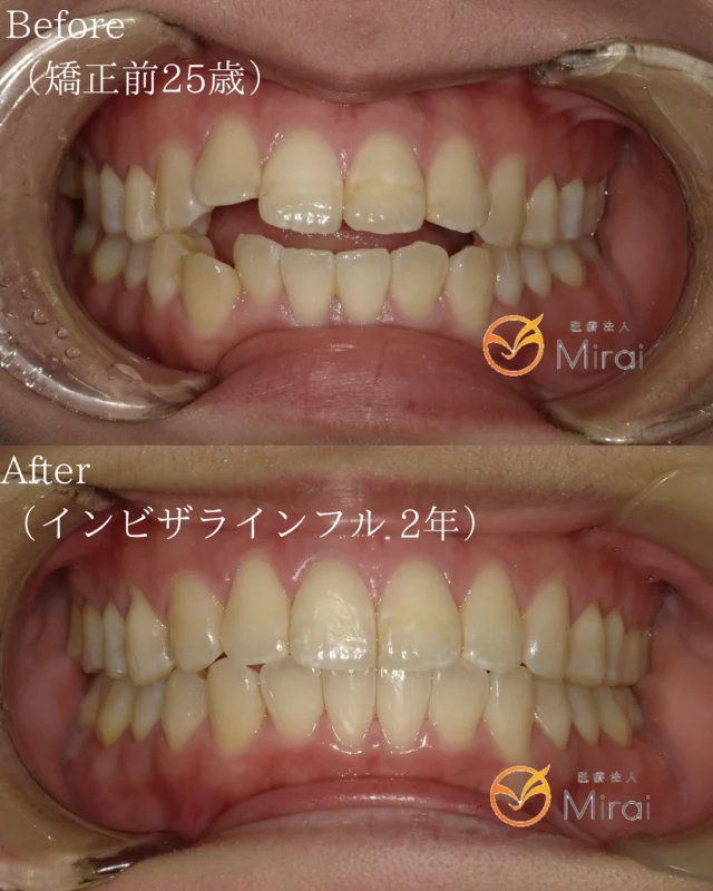 ガタガタの歯で笑顔に自信がない😿
でも大丈夫！インビザラインで歯の位置が整うことで、
魅力的な笑顔と良いかみ合わせが手に入ります🫶🫧
 
軽度から中程度のガタガタな歯並びでも、
インビザラインを使った適切な治療により、美しい歯並びへと導かれます🪞🫧

【Before】叢生を伴う開咬（オープンバイト）に対する
　　　　非抜歯矯正治療
⁡
【After】噛み合わせの揃った美しい歯並びに✨
⁡
【治療期間】2年
⁡
【費用】
　インビザラインフル　¥948,000
⁡
꧁ෆ————————————————————ෆ꧂
医療法人Mirai クラッセ歯科・矯正歯科
　 　 　 　 　 ルセラ歯科・矯正歯科 堺
 
診療時間
平日　10:00〜13:00 / 14:30〜19:00
土日　10:00〜13:00 / 14:00〜18:00
 
休診日
水曜日・祝日
 
他の症例は#Miraiインビザレポ　で検索してください🐩🫧
꧁ෆ————————————————————ෆ꧂
#Miraiインビザレポ
 
⁡
#歯科　#インビザライン　#マウスピース矯正
#叢生　#空隙　#反対咬合　#上顎前突　#開咬
#過蓋咬合 #歯列矯正 #無料相談 #綺麗な歯並び
#矯正レポ #インビザライン始めました #美しい歯並び
⁡
ーーーーーーーーーーーーーーーーーーーー
⁡
インビザラインに関する情報
 
▶️矯正治療の概要
インビザラインは、カスタムメイドのマウスピースを使って歯の位置を徐々に調整する矯正治療法です。定期的に新しいマウスピースに交換することで、適切な力を歯に加えて歯並びを整えます。
 
▶️治療期間と通院回数
治療期間は症状や方法によって異なりますが、一般的には約2年が目安です。通院は2〜3ヶ月に1回程度の割合で行われます。
 
▶️副作用やリスク
マウスピースの着用時間が不十分だと、治療期間が延びることがあります。また、他の矯正治療と同じく、疼痛、歯根吸収、歯肉退縮が起こる可能性があります。治療後に歯が元の位置に戻ることを防ぐためには、適切な保定が必要です。
 
▶️薬機法に関する注意事項
インビザライン完成品は、日本では薬機法の認可を受けていない矯正装置であり、医薬品副作用被害救済制度の適用外の場合があります。ただし、インビザラインの素材自体は日本の薬事認証を取得しています。インビザラインは、アメリカのアライン・テクノロジー社が製造し、インビザライン・ジャパン社が提供しています。日本では、類似の医療機器が薬事認証を受けています。インビザライン・システムは、世界100カ国以上で展開されており、2020年10月時点で900万人以上が治療を受けています。