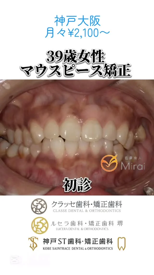 症例写真一覧👉@mirai_kyosei
ワイヤー併用無し、失敗しないインビザライン矯正なら医療法人Miraiへお任せください🪽
難症例やセカンドオピニオンでのご相談も可能です◎

39歳女性 上下顎叢生と第二大臼歯咬合以上に対する非抜歯矯正治療

#神戸矯正歯科 #堺矯正歯科 #インビザライン矯正