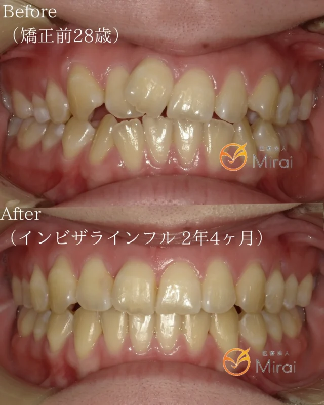 ガタガタの歯で笑顔に自信がない😿
でも大丈夫！インビザラインで歯の位置が整うことで、
魅力的な笑顔と良いかみ合わせが手に入ります🫶🫧
 
軽度から中程度のガタガタな歯並びでも、
インビザラインを使った適切な治療により、美しい歯並びへと導かれます🪞🫧

【Before】上下顎前突
⁡
【After】非抜歯矯正治療で美しい歯並びに✨
⁡
【治療期間】2年4ヶ月
⁡
【費用】
　インビザラインフル　¥948,000
⁡
꧁ෆ————————————————————ෆ꧂
医療法人Mirai クラッセ歯科・矯正歯科
　 　 　 　 　 ルセラ歯科・矯正歯科 堺
 
診療時間
平日　10:00〜13:00 / 14:30〜19:00
土日　10:00〜13:00 / 14:00〜18:00
 
休診日
水曜日・祝日
 
他の症例は#Miraiインビザレポ　で検索してください🐩🫧
꧁ෆ————————————————————ෆ꧂
#Miraiインビザレポ
 
⁡
#歯科　#インビザライン　#マウスピース矯正
#叢生　#空隙　#反対咬合　#上顎前突　#開咬
#過蓋咬合 #歯列矯正 #無料相談 #綺麗な歯並び
#矯正レポ #インビザライン始めました #美しい歯並び
⁡
ーーーーーーーーーーーーーーーーーーーー
⁡
インビザラインに関する情報
 
▶️矯正治療の概要
インビザラインは、カスタムメイドのマウスピースを使って歯の位置を徐々に調整する矯正治療法です。定期的に新しいマウスピースに交換することで、適切な力を歯に加えて歯並びを整えます。
 
▶️治療期間と通院回数
治療期間は症状や方法によって異なりますが、一般的には約2年が目安です。通院は2〜3ヶ月に1回程度の割合で行われます。
 
▶️副作用やリスク
マウスピースの着用時間が不十分だと、治療期間が延びることがあります。また、他の矯正治療と同じく、疼痛、歯根吸収、歯肉退縮が起こる可能性があります。治療後に歯が元の位置に戻ることを防ぐためには、適切な保定が必要です。
 
▶️薬機法に関する注意事項
インビザライン完成品は、日本では薬機法の認可を受けていない矯正装置であり、医薬品副作用被害救済制度の適用外の場合があります。ただし、インビザラインの素材自体は日本の薬事認証を取得しています。インビザラインは、アメリカのアライン・テクノロジー社が製造し、インビザライン・ジャパン社が提供しています。日本では、類似の医療機器が薬事認証を受けています。インビザライン・システムは、世界100カ国以上で展開されており、2020年10月時点で900万人以上が治療を受けています。