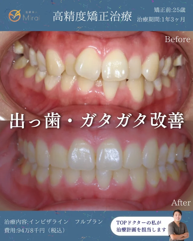 フルプランのみ、たった1年3ヶ月で改善🦷
PBMを使えば7ヶ月半ほどで治ります😊
スピード矯正もお任せください。
非抜歯・難症例も対応可能です🪽✨

#マウスピース矯正 #インビザライン#神戸矯正歯科 #堺矯正歯科