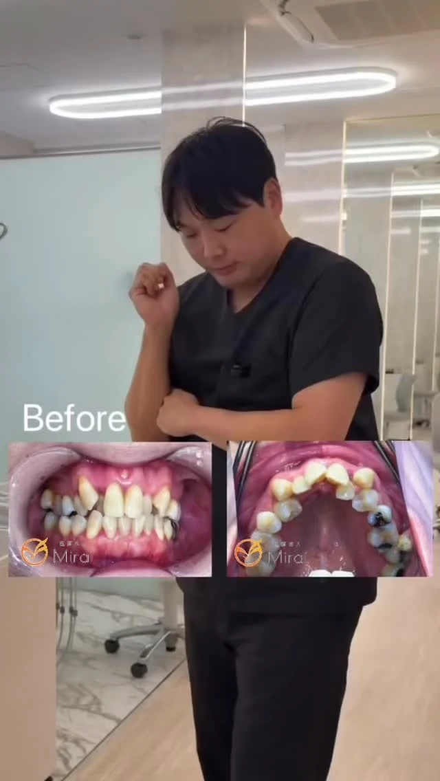 神戸大阪でインビザライン矯正なら、Dr.山﨑へ✨
他院でお断りされた重度の歯並びも対応可能です。

【Dr.山﨑の矯正認定実績 一覧】
▪︎TOPプロバイダー
▪︎インビザライン公認講師
▪︎ブラックダイヤモンドPV
▪︎PBMグローバルスピーカー

#マウスピース矯正 #神戸矯正歯科 #堺矯正歯科