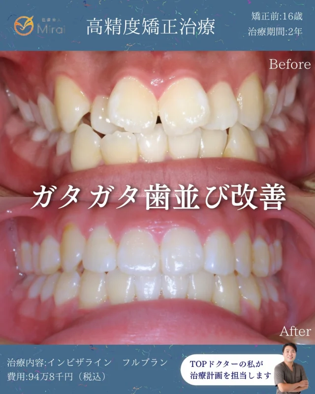 フルプランのみ、2年の非抜歯矯正で改善🦷
PBMを使えば1年ほどで治ります😊
スピード矯正もお任せください。
非抜歯・難症例も対応可能です🪽✨

#マウスピース矯正 #インビザライン#神戸矯正歯科 #堺矯正歯科