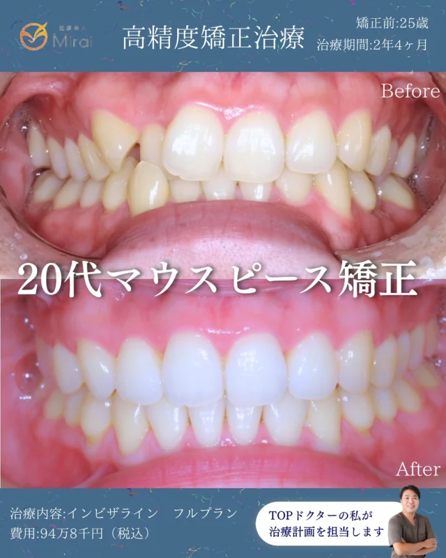 フルプランのみ、2年4ヶ月の非抜歯矯正で改善🦷
PBMを使えば1年2ヶ月ほどで治ります😊
スピード矯正もお任せください。
非抜歯・難症例もご相談ください🪽✨　

25歳女性 上下顎狭窄歯列と叢生に対する非抜歯矯正治療 2年4ヶ月
#マウスピース矯正 #インビザライン#神戸矯正歯科 #堺矯正歯科