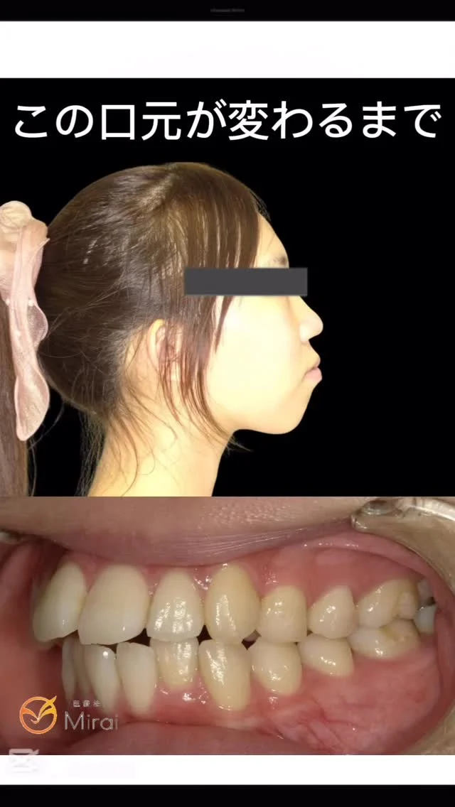 症例写真👉@mirai_kyosei
当院は部分矯正から抜歯症例や難症例まで対応しております。
治療計画は全て西日本最多の治療実績を誇る、インビザライン社公認講師のDr.山﨑圭一が担当いたしますので、安心して矯正治療を受けていただけます。

20歳女性 上下顎前突に対する第一小臼歯4本抜歯で治療した症例
治療期間:2年7ヶ月

他院でお断りされた難症例も改善できます✨
お気軽にご相談ください。
#マウスピース矯正 #神戸インビザライン #堺インビザライン