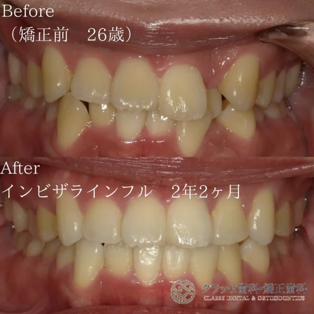 重度のガタガタの歯で笑顔を躊躇する😿
インビザラインなら、歯の位置を調整し
素晴らしい笑顔と適切なかみ合わせが実現できます🫶🫧
 
軽度から中程度のガタガタ歯並びでも、
インビザラインによる効果的な治療で、美しい歯並びを手に入れられます🪞🫧
 
【Before】上顎前突重度叢生
⁡
【After】重度の叢生でも非抜歯矯正治療で美しい歯並びに✨
⁡
【治療期間】2年2ヶ月
⁡
【費用】
　インビザラインフル　¥858,000
⁡
꧁ෆ————————————————————ෆ꧂
医療法人Mirai クラッセ歯科・矯正歯科
　 　 　 　 　 ルセラ歯科・矯正歯科 堺
 
診療時間
平日　10:00〜13:00 / 14:30〜19:00
土日　10:00〜13:00 / 14:00〜18:00
 
休診日
水曜日・祝日
 
他の症例は#Miraiインビザレポ　で検索してください🐩🫧
꧁ෆ————————————————————ෆ꧂
#Miraiインビザレポ
 
⁡
#歯科　#インビザライン　#マウスピース矯正
#叢生　#空隙　#反対咬合　#上顎前突　#開咬
#過蓋咬合 #歯列矯正 #無料相談 #綺麗な歯並び
#矯正レポ #インビザライン始めました #美しい歯並び
⁡
ーーーーーーーーーーーーーーーーーーーー
⁡
インビザラインに関する情報
 
▶️矯正治療の概要
インビザラインは、カスタムメイドのマウスピースを使って歯の位置を徐々に調整する矯正治療法です。定期的に新しいマウスピースに交換することで、適切な力を歯に加えて歯並びを整えます。
 
▶️治療期間と通院回数
治療期間は症状や方法によって異なりますが、一般的には約2年が目安です。通院は2〜3ヶ月に1回程度の割合で行われます。
 
▶️副作用やリスク
マウスピースの着用時間が不十分だと、治療期間が延びることがあります。また、他の矯正治療と同じく、疼痛、歯根吸収、歯肉退縮が起こる可能性があります。治療後に歯が元の位置に戻ることを防ぐためには、適切な保定が必要です。
 
▶️薬機法に関する注意事項
インビザライン完成品は、日本では薬機法の認可を受けていない矯正装置であり、医薬品副作用被害救済制度の適用外の場合があります。ただし、インビザラインの素材自体は日本の薬事認証を取得しています。インビザラインは、アメリカのアライン・テクノロジー社が製造し、インビザライン・ジャパン社が提供しています。日本では、類似の医療機器が薬事認証を受けています。インビザライン・システムは、世界100カ国以上で展開されており、2020年10月時点で900万人以上が治療を受けています。