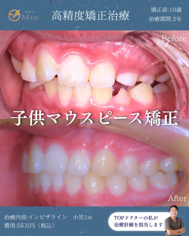 小児1stプラン、
2年で理想の歯並びに改善🦷

お子さまの矯正実積多数アリ😊

当院だからできる、
３日交換でのスピード小児矯正で
お子さまの負担も軽減できます。

将来のための歯並び治療、始めませんか？✨

10歳男性 上下叢生に対する予防矯正治療2年

＃小児矯正＃神戸矯正歯科#堺矯正歯科