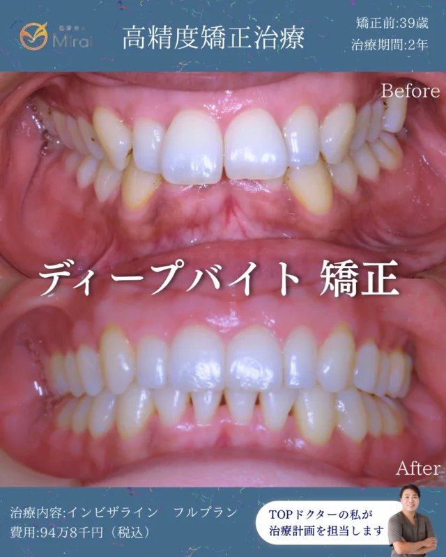 フルプランのみ、2年の非抜歯矯正で改善🦷
PBMを使えば1年ほどで治ります😊
スピード矯正もお任せください。
非抜歯・難症例もご相談ください🪽✨　

39歳女性 上顎前突ディープバイト叢生に対する非抜歯矯正治療 2年
#マウスピース矯正 #インビザライン#神戸矯正歯科 #堺矯正歯科