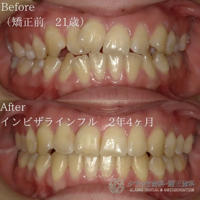 ガタガタの歯で笑顔を見せるのが恥ずかしい😿
インビザラインを利用すれば、歯の位置を整えて
魅力的な笑顔と良好なかみ合わせが得られます🫶🫧
 
軽度から中程度のガタガタ歯並びも、
インビザラインの適切な矯正治療で美しい歯並びに変わります🪞🫧

【Before】上下顎前突
⁡
【After】非抜歯矯正治療で美しい歯並びに✨
⁡
【治療期間】2年4ヶ月
⁡
【費用】
　インビザラインフル　¥858,000
⁡
꧁ෆ————————————————————ෆ꧂
医療法人Mirai クラッセ歯科・矯正歯科
　 　 　 　 　 ルセラ歯科・矯正歯科 堺
 
診療時間
平日　10:00〜13:00 / 14:30〜19:00
土日　10:00〜13:00 / 14:00〜18:00
 
休診日
水曜日・祝日
 
他の症例は#Miraiインビザレポ　で検索してください🐩🫧
꧁ෆ————————————————————ෆ꧂
#Miraiインビザレポ
 
⁡
#歯科　#インビザライン　#マウスピース矯正
#叢生　#空隙　#反対咬合　#上顎前突　#開咬
#過蓋咬合 #歯列矯正 #無料相談 #綺麗な歯並び
#矯正レポ #インビザライン始めました #美しい歯並び
⁡
ーーーーーーーーーーーーーーーーーーーー
⁡
インビザラインに関する情報
 
▶️矯正治療の概要
インビザラインは、カスタムメイドのマウスピースを使って歯の位置を徐々に調整する矯正治療法です。定期的に新しいマウスピースに交換することで、適切な力を歯に加えて歯並びを整えます。
 
▶️治療期間と通院回数
治療期間は症状や方法によって異なりますが、一般的には約2年が目安です。通院は2〜3ヶ月に1回程度の割合で行われます。
 
▶️副作用やリスク
マウスピースの着用時間が不十分だと、治療期間が延びることがあります。また、他の矯正治療と同じく、疼痛、歯根吸収、歯肉退縮が起こる可能性があります。治療後に歯が元の位置に戻ることを防ぐためには、適切な保定が必要です。
 
▶️薬機法に関する注意事項
インビザライン完成品は、日本では薬機法の認可を受けていない矯正装置であり、医薬品副作用被害救済制度の適用外の場合があります。ただし、インビザラインの素材自体は日本の薬事認証を取得しています。インビザラインは、アメリカのアライン・テクノロジー社が製造し、インビザライン・ジャパン社が提供しています。日本では、類似の医療機器が薬事認証を受けています。インビザライン・システムは、世界100カ国以上で展開されており、2020年10月時点で900万人以上が治療を受けています。