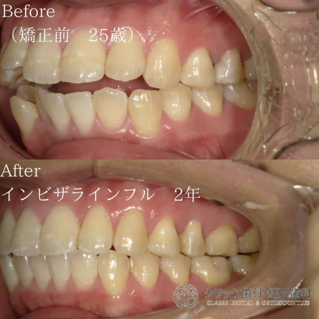 出っ歯で笑顔に自信が持てない😿
インビザラインを使えば、出っ歯も矯正され
かみ合わせも良くなり、素晴らしい笑顔に変身🫶✨
 
軽度から中程度の出っ歯の問題に対しては、
短期間で治療が完了する可能性もあります🪞✨
 

【Before】叢生を伴う開咬（オープンバイト）
⁡
【After】非抜歯矯正治療で美しい歯並びに💐
⁡
【治療期間】２年
⁡
【費用】
　インビザラインフル　¥798,000
⁡
꧁ෆ————————————————————ෆ꧂
医療法人Mirai クラッセ歯科・矯正歯科
　 　 　 　 　 ルセラ歯科・矯正歯科 堺
 
診療時間
平日　10:00〜13:00 / 14:30〜19:00
土日　10:00〜13:00 / 14:00〜18:00
 
休診日
水曜日・祝日
 
他の症例は#Miraiインビザレポ　で検索してください🐩🫧
꧁ෆ————————————————————ෆ꧂
#Miraiインビザレポ
 
⁡
#歯科　#インビザライン　#マウスピース矯正
#叢生　#空隙　#反対咬合　#上顎前突　#開咬
#過蓋咬合 #歯列矯正 #無料相談 #綺麗な歯並び
#矯正レポ #インビザライン始めました #美しい歯並び
⁡
ーーーーーーーーーーーーーーーーーーーー
⁡
インビザラインに関する情報
 
▶️矯正治療の概要
インビザラインは、カスタムメイドのマウスピースを使って歯の位置を徐々に調整する矯正治療法です。定期的に新しいマウスピースに交換することで、適切な力を歯に加えて歯並びを整えます。
 
▶️治療期間と通院回数
治療期間は症状や方法によって異なりますが、一般的には約2年が目安です。通院は2〜3ヶ月に1回程度の割合で行われます。
 
▶️副作用やリスク
マウスピースの着用時間が不十分だと、治療期間が延びることがあります。また、他の矯正治療と同じく、疼痛、歯根吸収、歯肉退縮が起こる可能性があります。治療後に歯が元の位置に戻ることを防ぐためには、適切な保定が必要です。
 
▶️薬機法に関する注意事項
インビザライン完成品は、日本では薬機法の認可を受けていない矯正装置であり、医薬品副作用被害救済制度の適用外の場合があります。ただし、インビザラインの素材自体は日本の薬事認証を取得しています。インビザラインは、アメリカのアライン・テクノロジー社が製造し、インビザライン・ジャパン社が提供しています。日本では、類似の医療機器が薬事認証を受けています。インビザライン・システムは、世界100カ国以上で展開されており、2020年10月時点で900万人以上が治療を受けています。