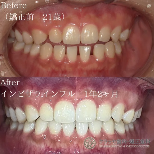 すきっ歯で笑顔に自信が持てない😿
インビザラインを使えば、隙間もちゃんと埋まって
かみ合わせも良くなり、素晴らしい笑顔に変身🫶✨
 
軽度から中程度の歯並びの問題に対しては、
短期間で治療が完了する可能性もあります🪞✨

【Before】前歯部開噛空隙歯列
⁡
【After】非抜歯矯正治療で美しい歯並びに✨
⁡
【治療期間】1年2ヶ月（追加アライナー無し）
⁡
【費用】
　インビザラインフル　¥798,000
⁡
꧁ෆ————————————————————ෆ꧂
医療法人Mirai クラッセ歯科・矯正歯科
　 　 　 　 　 ルセラ歯科・矯正歯科 堺
 
診療時間
平日　10:00〜13:00 / 14:30〜19:00
土日　10:00〜13:00 / 14:00〜18:00
 
休診日
水曜日・祝日
 
他の症例は#Miraiインビザレポ　で検索してください🐩🫧
꧁ෆ————————————————————ෆ꧂
#Miraiインビザレポ
 
⁡
#歯科　#インビザライン　#マウスピース矯正
#叢生　#空隙　#反対咬合　#上顎前突　#開咬
#過蓋咬合 #歯列矯正 #無料相談 #綺麗な歯並び
#矯正レポ #インビザライン始めました #美しい歯並び
⁡
ーーーーーーーーーーーーーーーーーーーー
⁡
インビザラインに関する情報
 
▶️矯正治療の概要
インビザラインは、カスタムメイドのマウスピースを使って歯の位置を徐々に調整する矯正治療法です。定期的に新しいマウスピースに交換することで、適切な力を歯に加えて歯並びを整えます。
 
▶️治療期間と通院回数
治療期間は症状や方法によって異なりますが、一般的には約2年が目安です。通院は2〜3ヶ月に1回程度の割合で行われます。
 
▶️副作用やリスク
マウスピースの着用時間が不十分だと、治療期間が延びることがあります。また、他の矯正治療と同じく、疼痛、歯根吸収、歯肉退縮が起こる可能性があります。治療後に歯が元の位置に戻ることを防ぐためには、適切な保定が必要です。
 
▶️薬機法に関する注意事項
インビザライン完成品は、日本では薬機法の認可を受けていない矯正装置であり、医薬品副作用被害救済制度の適用外の場合があります。ただし、インビザラインの素材自体は日本の薬事認証を取得しています。インビザラインは、アメリカのアライン・テクノロジー社が製造し、インビザライン・ジャパン社が提供しています。日本では、類似の医療機器が薬事認証を受けています。インビザライン・システムは、世界100カ国以上で展開されており、2020年10月時点で900万人以上が治療を受けています。
