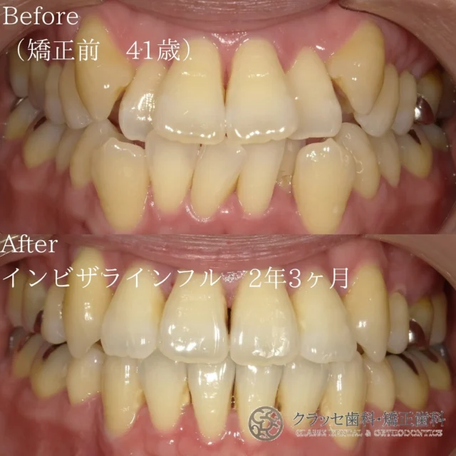 ガタガタの歯で笑顔が自信に欠ける😿
でも心配無用！インビザラインで歯の整列が可能で、
素敵な笑顔と快適なかみ合わせが実現します🫶🫧
 
軽度から中程度のガタガタ歯でも、
インビザラインの効果的な治療で美しく整った歯並びが手に入ります🪞🫧

⁡
【Before】上下顎重度叢生
⁡
【After】上下顎両側第一小臼歯抜歯による矯正治療
重度の歯並びでもマウスピースのみで改善✨
⁡
【治療期間】2年3ヶ月
⁡
【費用】
　インビザラインフル　¥858,000
⁡
꧁ෆ————————————————————ෆ꧂
医療法人Mirai クラッセ歯科・矯正歯科
　 　 　 　 　 ルセラ歯科・矯正歯科 堺
 
診療時間
平日　10:00〜13:00 / 14:30〜19:00
土日　10:00〜13:00 / 14:00〜18:00
 
休診日
水曜日・祝日
 
他の症例は#Miraiインビザレポ　で検索してください🐩🫧
꧁ෆ————————————————————ෆ꧂
#Miraiインビザレポ
 
⁡
#歯科　#インビザライン　#マウスピース矯正
#叢生　#空隙　#反対咬合　#上顎前突　#開咬
#過蓋咬合 #歯列矯正 #無料相談 #綺麗な歯並び
#矯正レポ #インビザライン始めました #美しい歯並び
⁡
ーーーーーーーーーーーーーーーーーーーー
⁡
インビザラインに関する情報
 
▶️矯正治療の概要
インビザラインは、カスタムメイドのマウスピースを使って歯の位置を徐々に調整する矯正治療法です。定期的に新しいマウスピースに交換することで、適切な力を歯に加えて歯並びを整えます。
 
▶️治療期間と通院回数
治療期間は症状や方法によって異なりますが、一般的には約2年が目安です。通院は2〜3ヶ月に1回程度の割合で行われます。
 
▶️副作用やリスク
マウスピースの着用時間が不十分だと、治療期間が延びることがあります。また、他の矯正治療と同じく、疼痛、歯根吸収、歯肉退縮が起こる可能性があります。治療後に歯が元の位置に戻ることを防ぐためには、適切な保定が必要です。
 
▶️薬機法に関する注意事項
インビザライン完成品は、日本では薬機法の認可を受けていない矯正装置であり、医薬品副作用被害救済制度の適用外の場合があります。ただし、インビザラインの素材自体は日本の薬事認証を取得しています。インビザラインは、アメリカのアライン・テクノロジー社が製造し、インビザライン・ジャパン社が提供しています。日本では、類似の医療機器が薬事認証を受けています。インビザライン・システムは、世界100カ国以上で展開されており、2020年10月時点で900万人以上が治療を受けています。