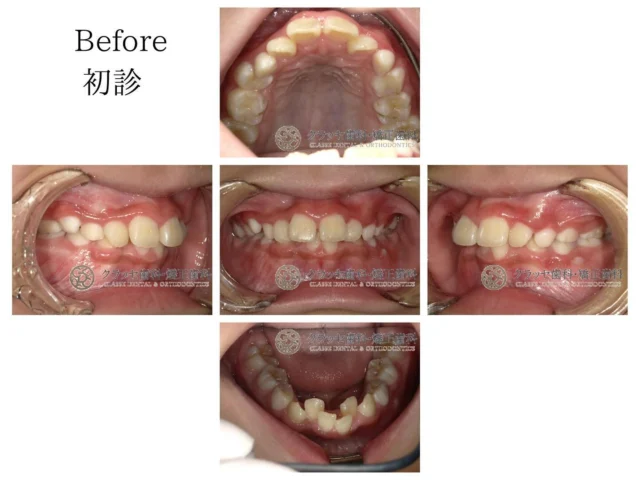 ガタガタの歯で笑顔を見せるのが恥ずかしい😿
インビザラインを利用すれば、歯の位置を整えて
魅力的な笑顔と良好なかみ合わせが得られます🫶🫧
 
軽度から中程度のガタガタ歯並びも、
インビザラインの適切な矯正治療で美しい歯並びに変わります🪞🫧

【Before】9歳、上下顎叢生と上顎前突
⁡
【After】予防矯正治療で美しい歯並びに✨
子供の矯正は大人になってからも後戻りしにくくオススメです。
⁡
【治療期間】2年
⁡
【費用】
　インビザラインファースト　¥550,000
⁡
꧁ෆ————————————————————ෆ꧂
医療法人Mirai クラッセ歯科・矯正歯科
　 　 　 　 　 ルセラ歯科・矯正歯科 堺
 
診療時間
平日　10:00〜13:00 / 14:30〜19:00
土日　10:00〜13:00 / 14:00〜18:00
 
休診日
水曜日・祝日
 
他の症例は#Miraiインビザレポ　で検索してください🐩🫧
꧁ෆ————————————————————ෆ꧂
#Miraiインビザレポ
 
⁡
#歯科　#インビザライン　#マウスピース矯正
#叢生　#空隙　#反対咬合　#上顎前突　#開咬
#過蓋咬合 #歯列矯正 #無料相談 #綺麗な歯並び
#矯正レポ #インビザライン始めました #美しい歯並び
⁡
ーーーーーーーーーーーーーーーーーーーー
⁡
インビザラインに関する情報
 
▶️矯正治療の概要
インビザラインは、カスタムメイドのマウスピースを使って歯の位置を徐々に調整する矯正治療法です。定期的に新しいマウスピースに交換することで、適切な力を歯に加えて歯並びを整えます。
 
▶️治療期間と通院回数
治療期間は症状や方法によって異なりますが、一般的には約2年が目安です。通院は2〜3ヶ月に1回程度の割合で行われます。
 
▶️副作用やリスク
マウスピースの着用時間が不十分だと、治療期間が延びることがあります。また、他の矯正治療と同じく、疼痛、歯根吸収、歯肉退縮が起こる可能性があります。治療後に歯が元の位置に戻ることを防ぐためには、適切な保定が必要です。
 
▶️薬機法に関する注意事項
インビザライン完成品は、日本では薬機法の認可を受けていない矯正装置であり、医薬品副作用被害救済制度の適用外の場合があります。ただし、インビザラインの素材自体は日本の薬事認証を取得しています。インビザラインは、アメリカのアライン・テクノロジー社が製造し、インビザライン・ジャパン社が提供しています。日本では、類似の医療機器が薬事認証を受けています。インビザライン・システムは、世界100カ国以上で展開されており、2020年10月時点で900万人以上が治療を受けています。