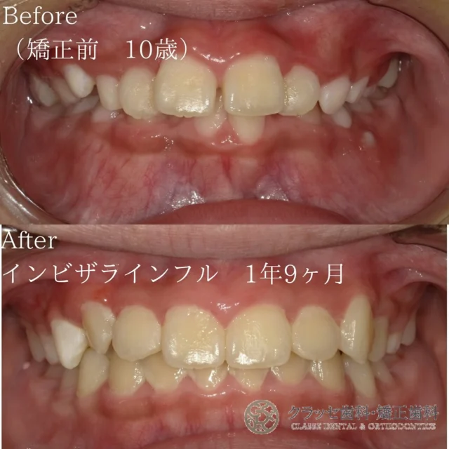 ガタガタの歯で笑顔を躊躇する😿
インビザラインなら、歯の位置を調整し
素晴らしい笑顔と適切なかみ合わせが実現できます🫶🫧
 
軽度から中程度のガタガタ歯並びでも、
インビザラインによる効果的な治療で、美しい歯並びを手に入れられます🪞🫧

【Before】上顎前突 叢生 過蓋咬合症例
⁡
【After】上顎前突と叢生を伴う過蓋咬合に対する1期矯正治療で美しい歯並びに✨
小児矯正でお口の悪いクセを改善すると、
大人の矯正より後戻りしにくくなります。
⁡
【治療期間】1年9ヶ月
⁡
【費用】
　インビザライン1st
⁡
꧁ෆ————————————————————ෆ꧂
医療法人Mirai クラッセ歯科・矯正歯科
　 　 　 　 　 ルセラ歯科・矯正歯科 堺
 
診療時間
平日　10:00〜13:00 / 14:30〜19:00
土日　10:00〜13:00 / 14:00〜18:00
 
休診日
水曜日・祝日
 
他の症例は#Miraiインビザレポ　で検索してください🐩🫧
꧁ෆ————————————————————ෆ꧂
#Miraiインビザレポ
 
⁡
#歯科　#インビザライン　#マウスピース矯正
#叢生　#空隙　#反対咬合　#上顎前突　#開咬
#過蓋咬合 #歯列矯正 #無料相談 #綺麗な歯並び
#矯正レポ #インビザライン始めました #美しい歯並び
⁡
ーーーーーーーーーーーーーーーーーーーー
⁡
インビザラインに関する情報
 
▶️矯正治療の概要
インビザラインは、カスタムメイドのマウスピースを使って歯の位置を徐々に調整する矯正治療法です。定期的に新しいマウスピースに交換することで、適切な力を歯に加えて歯並びを整えます。
 
▶️治療期間と通院回数
治療期間は症状や方法によって異なりますが、一般的には約2年が目安です。通院は2〜3ヶ月に1回程度の割合で行われます。
 
▶️副作用やリスク
マウスピースの着用時間が不十分だと、治療期間が延びることがあります。また、他の矯正治療と同じく、疼痛、歯根吸収、歯肉退縮が起こる可能性があります。治療後に歯が元の位置に戻ることを防ぐためには、適切な保定が必要です。
 
▶️薬機法に関する注意事項
インビザライン完成品は、日本では薬機法の認可を受けていない矯正装置であり、医薬品副作用被害救済制度の適用外の場合があります。ただし、インビザラインの素材自体は日本の薬事認証を取得しています。インビザラインは、アメリカのアライン・テクノロジー社が製造し、インビザライン・ジャパン社が提供しています。日本では、類似の医療機器が薬事認証を受けています。インビザライン・システムは、世界100カ国以上で展開されており、2020年10月時点で900万人以上が治療を受けています。