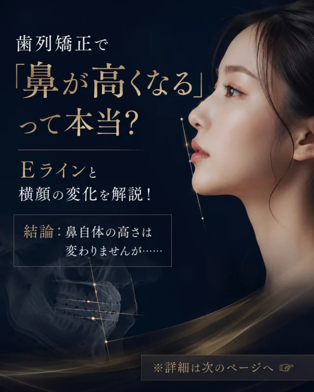 「矯正で、横顔の印象が変わる理由。」
「矯正後に、鼻筋がすっきりと見えた」——そんなお声を聞くことがあります。
お顔の骨格そのものや、鼻の高さが変わるわけではありません。

ですが、美しさの決め手となる「Eライン（エステティックライン）」が正しく整うことで、鼻筋からあご先にかけてのラインが驚くほど美しく際立つのです。

口元の突出感が抑えられることで生まれる、計算された横顔の立体感。
それが「鼻が高くなった」ような洗練された印象をもたらします。

医療法人Miraiでは、Dr.山﨑がお一人おひとりの骨格とEラインのバランスを緻密に計算し、単に歯を並べるだけでなく「お顔全体の美しさ
」を高める治療をご提案しております。

横顔のシルエットや口元のバランスでお悩みの方は、ぜひ当院の無料カウンセリングでお気軽にご相談ください。

◆ ご予約・詳細はプロフィールのlitlinkから🪽
#Eライン #歯列矯正 #インビザライン